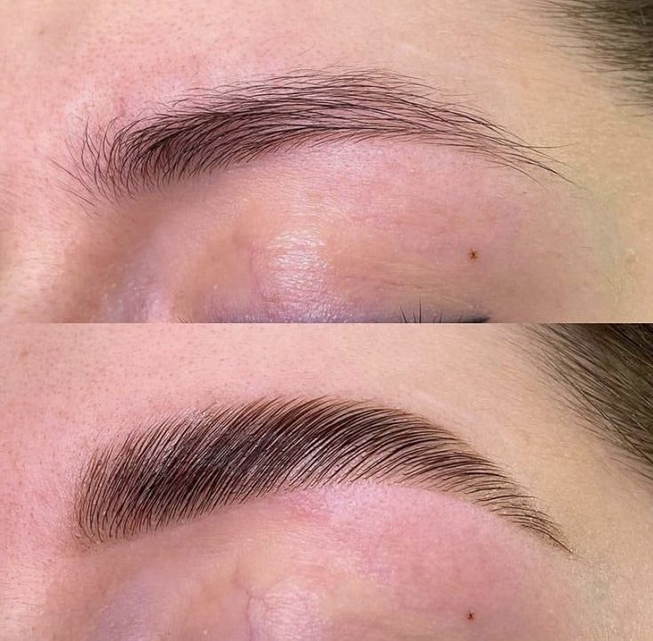 Browlift